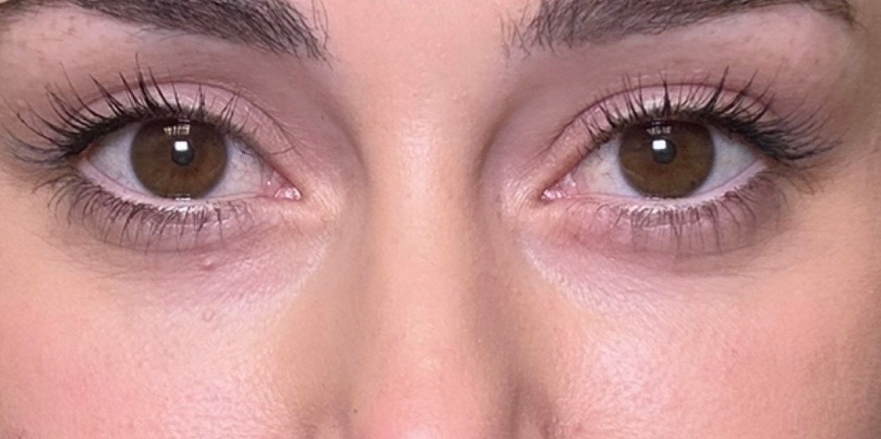 Biofiller Under-Eye — after result at DK Aesthetics, Highland Park IL