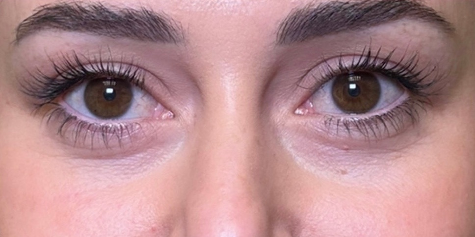 Biofiller Under-Eye — before, at DK Aesthetics, Highland Park IL