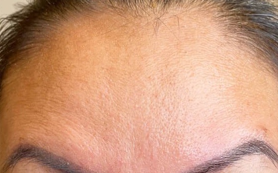 Botox — after result at DK Aesthetics, Highland Park IL