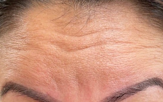 Botox — before, at DK Aesthetics, Highland Park IL
