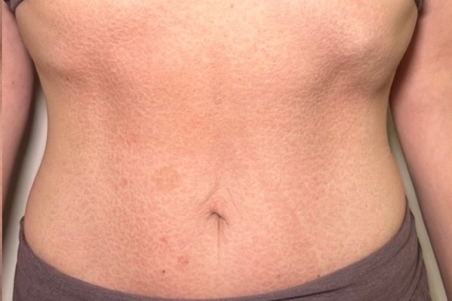 After Emsculpt Neo at DK Aesthetics Highland Park