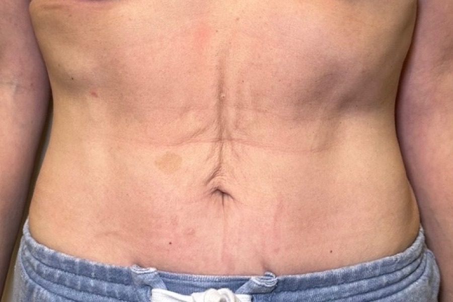 Before Emsculpt Neo at DK Aesthetics Highland Park