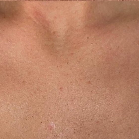 IPL Photofacial — after result at DK Aesthetics, Highland Park IL