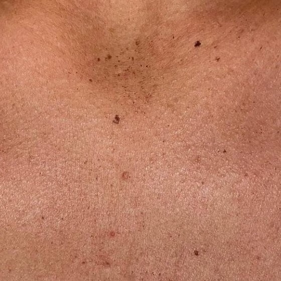 IPL Photofacial — before, at DK Aesthetics, Highland Park IL