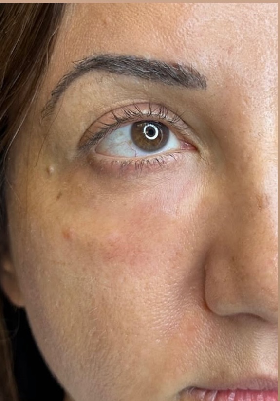 PRF Under-Eye Filler — after result at DK Aesthetics, Highland Park IL