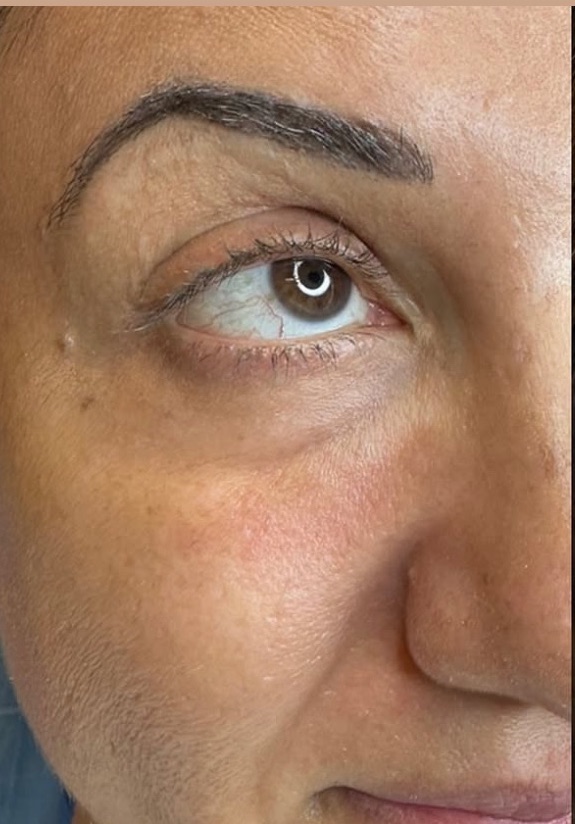 PRF Under-Eye Filler — before, at DK Aesthetics, Highland Park IL