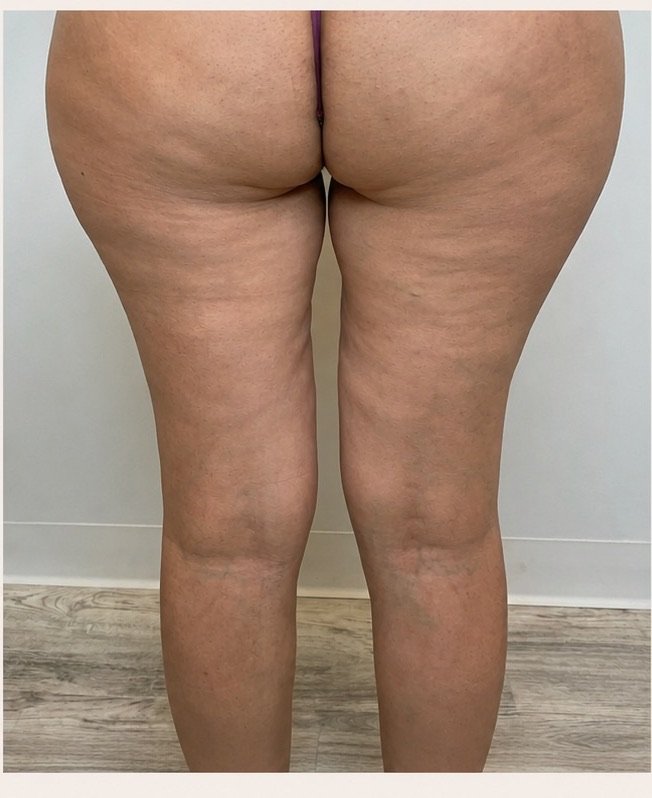 Cellulite Treatment — after result at DK Aesthetics, Highland Park IL