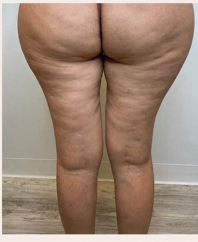 Cellulite Treatment — before, at DK Aesthetics, Highland Park IL