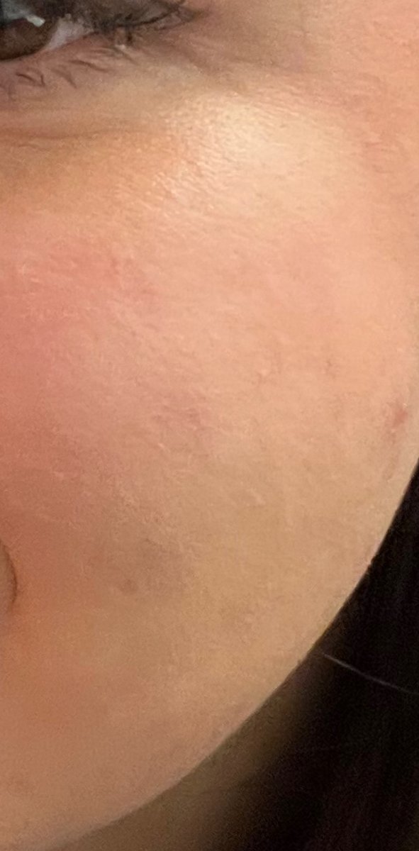 Acne Treatment — after result at DK Aesthetics, Highland Park IL