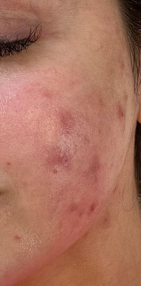 Acne Treatment — before, at DK Aesthetics, Highland Park IL
