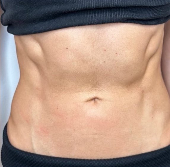 After Emsculpt Neo at DK Aesthetics Highland Park