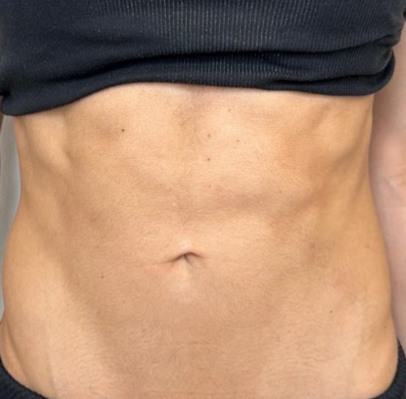 Before Emsculpt Neo at DK Aesthetics Highland Park