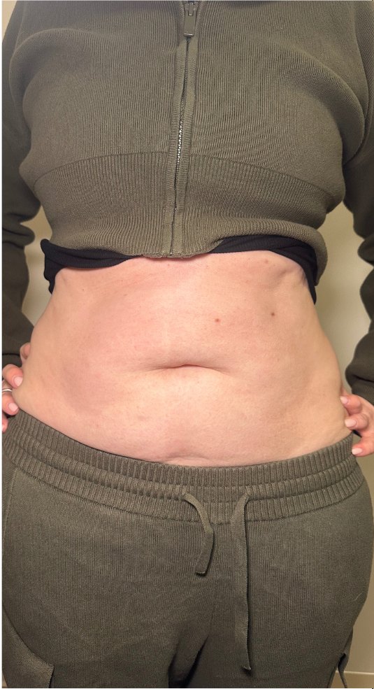 After Emsculpt Neo at DK Aesthetics Highland Park