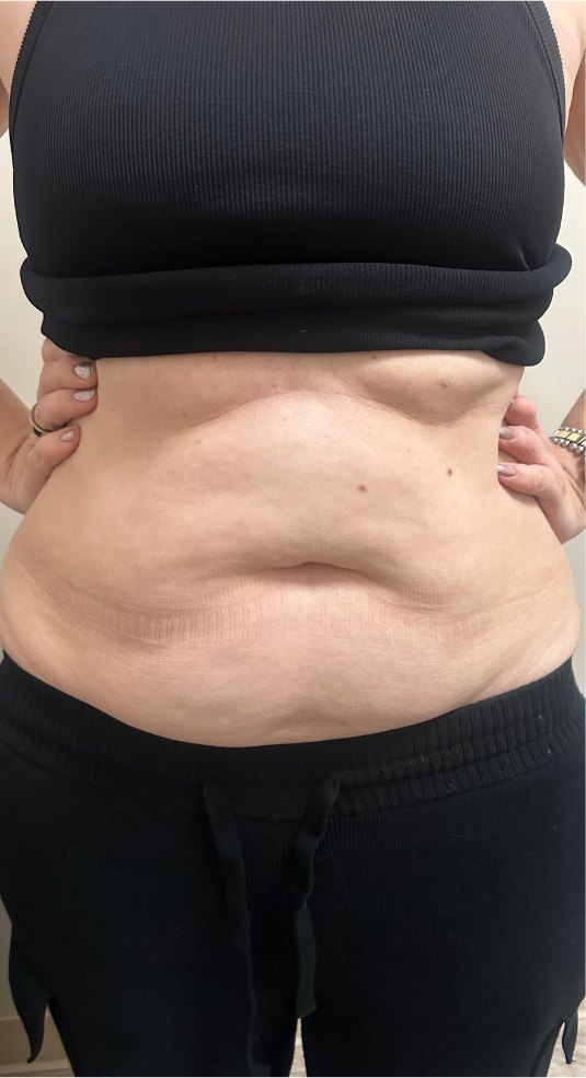 Before Emsculpt Neo at DK Aesthetics Highland Park