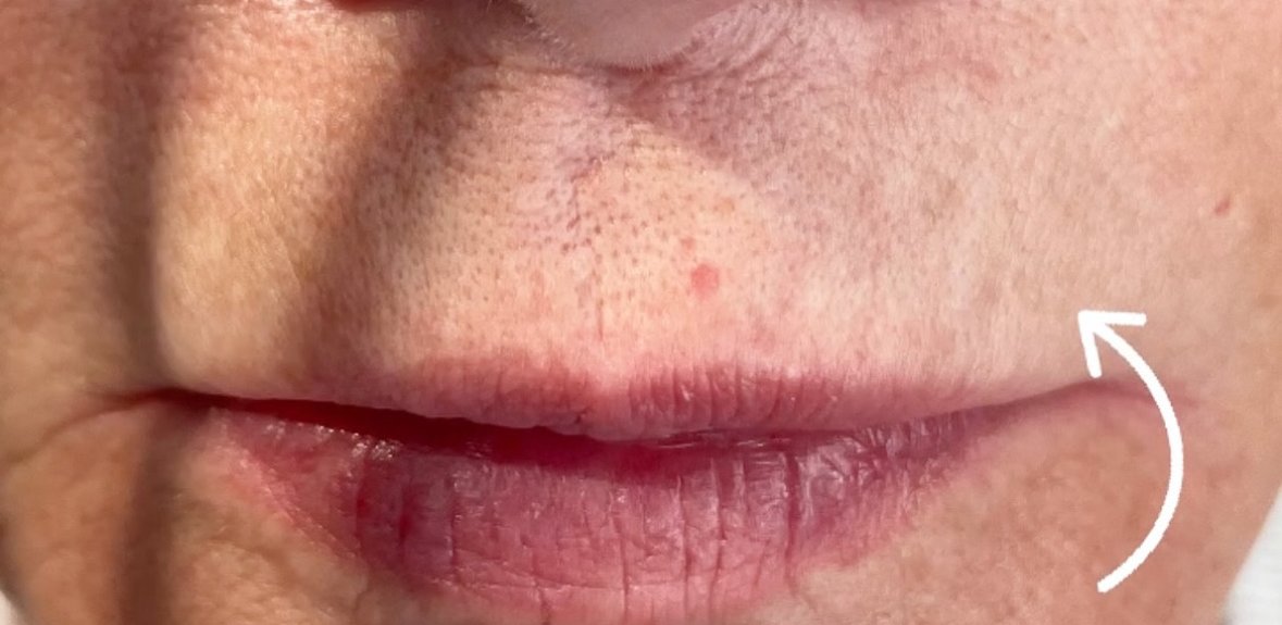Fractional RF — after result at DK Aesthetics, Highland Park IL