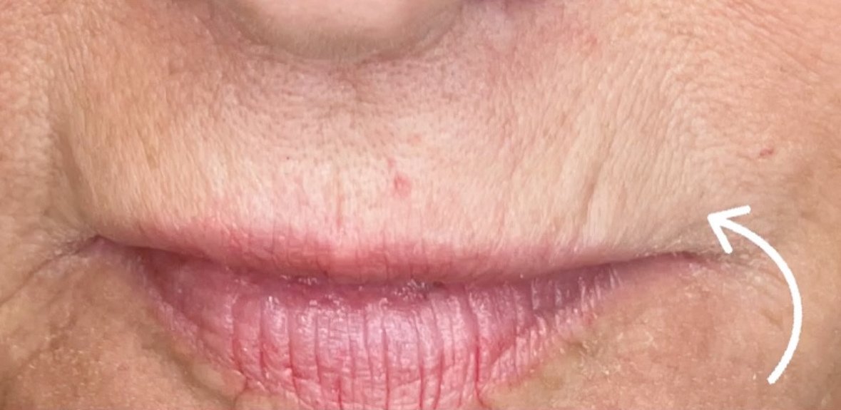 Fractional RF — before, at DK Aesthetics, Highland Park IL