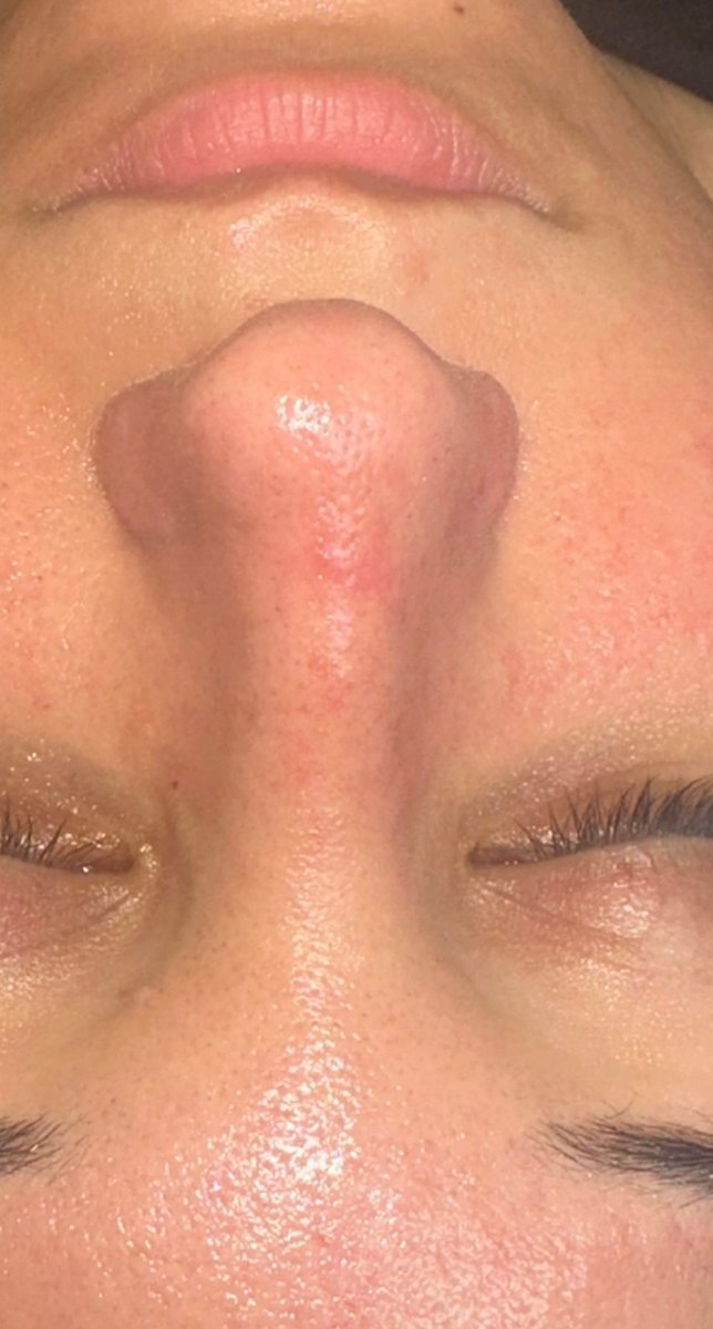 Deep-Cleansing Facial — after result at DK Aesthetics, Highland Park IL