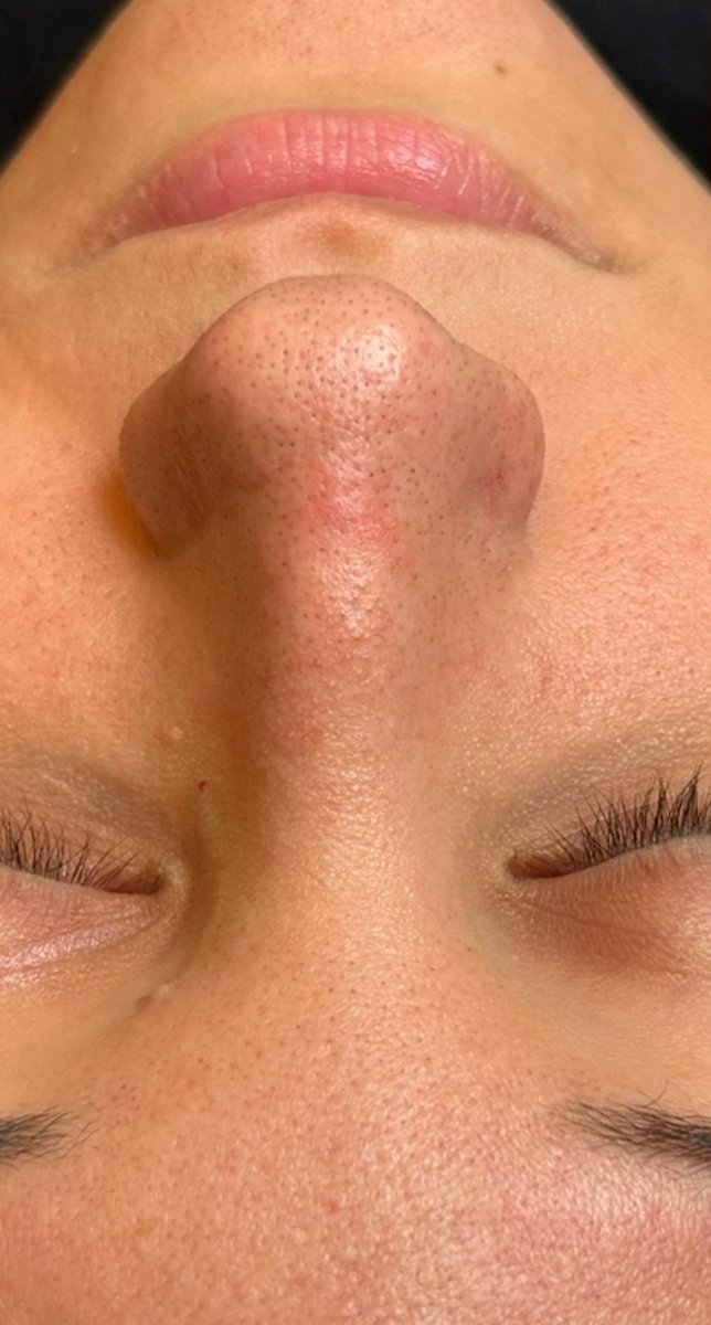 Deep-Cleansing Facial — before, at DK Aesthetics, Highland Park IL