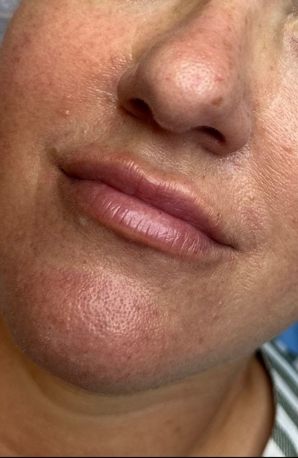 Lip Blushing — before, at DK Aesthetics, Highland Park IL