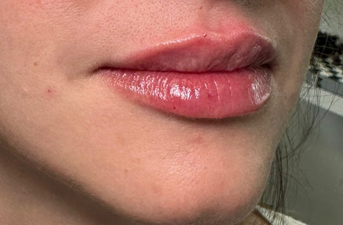 Lip Filler — after result at DK Aesthetics, Highland Park IL
