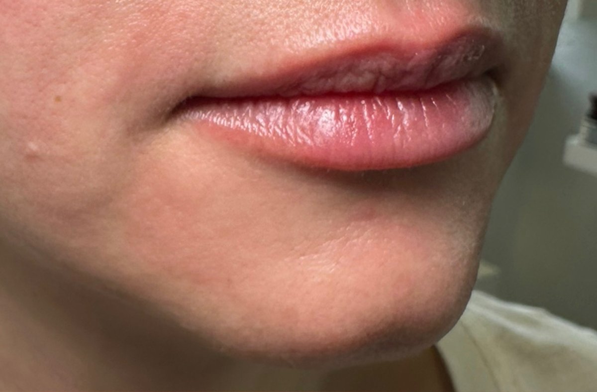 Lip Filler — before, at DK Aesthetics, Highland Park IL